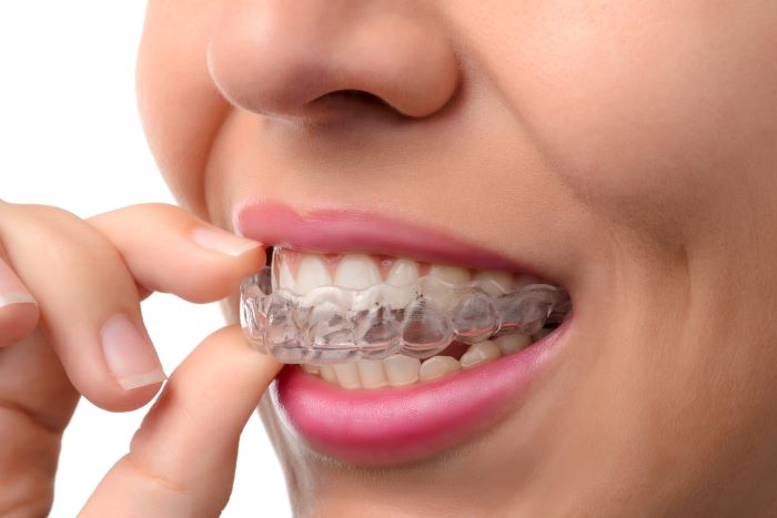 What is Invisalign in Sandpoint