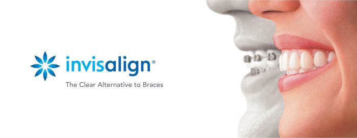 Invisalign for Adults Sandpoint